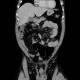 Inflammatory tumour of descending colon, CT colonography: CT - Computed tomography